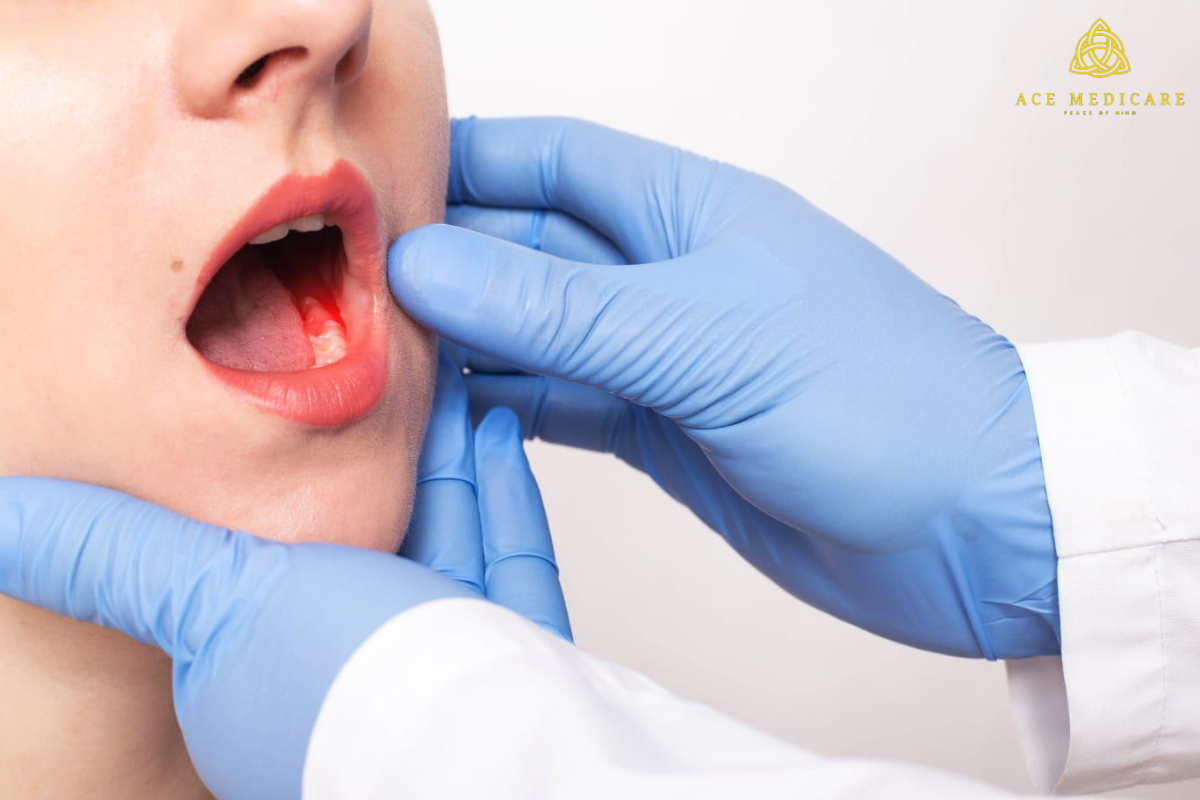 Understanding Oral Cancer: Causes, Symptoms, and Treatment Options